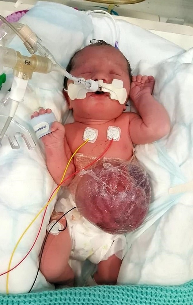 Young Girl Who Was Born With Stomach, Bowel And Liver Outside Her Body