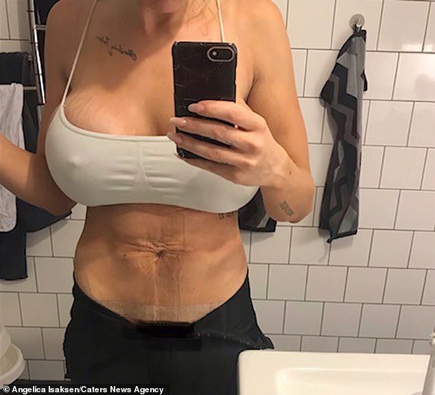 botched breast implants
