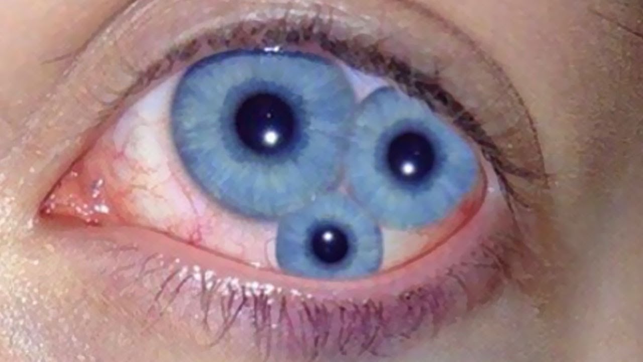 eye with no pupil