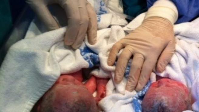 Alessandro y Andrea: el caso "excepcional" de gemelos que nacieron ...