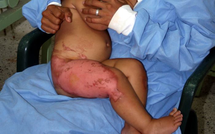 Muere niña que había resultado quemada con agua caliente | Muerte ...