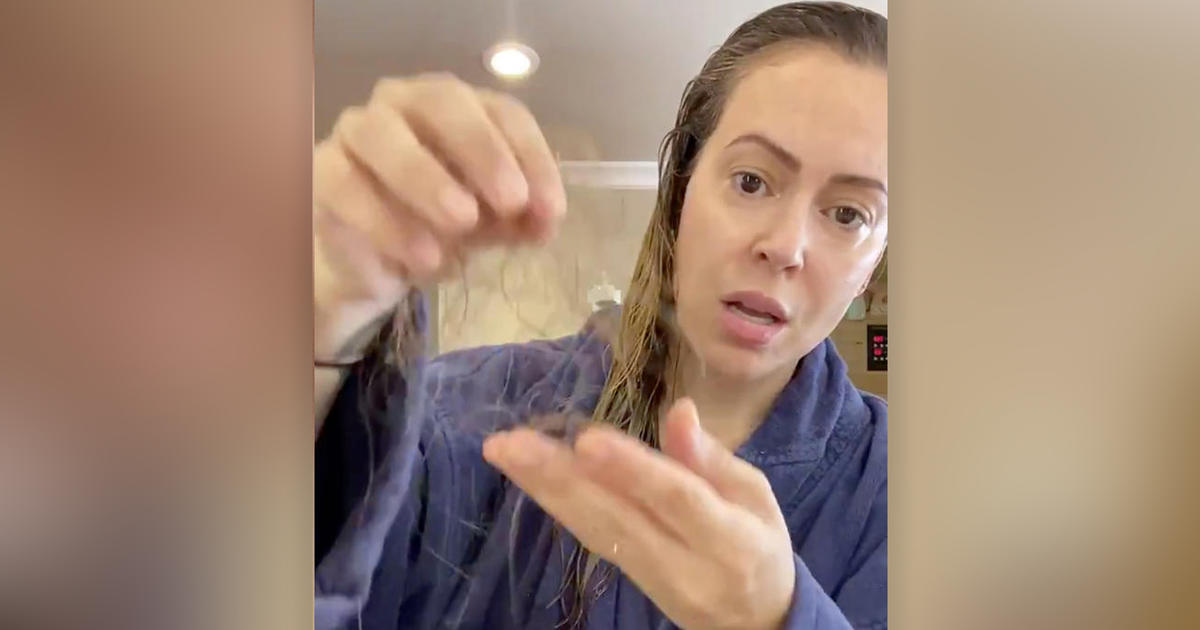 hair loss