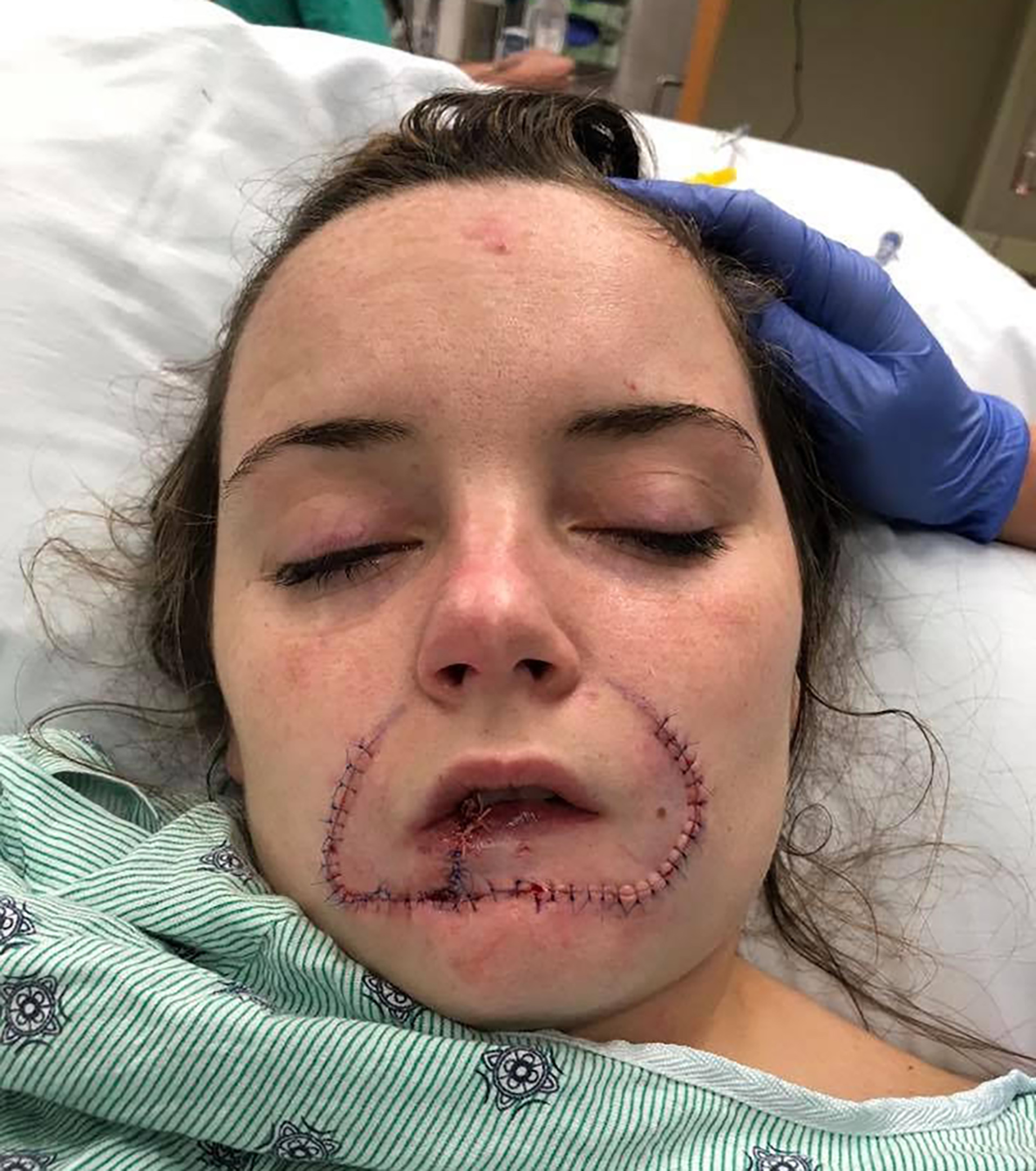 Condenado a 12 años de prisión el estadounidense que arrancó de un mordisco el labio de su ex novia - Infobae