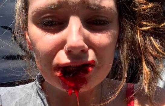 Hombre arrancó el labio de su exnovia de una mordida