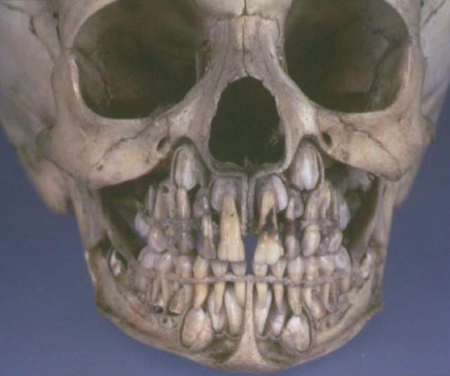 baby skull teeth 