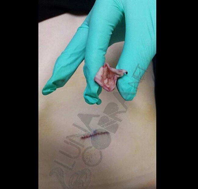 belly button removal