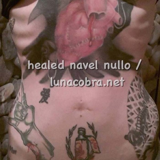 belly button removals