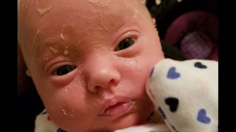 Una madre pide ayuda para tratar a su hija con "piel de serpiente"