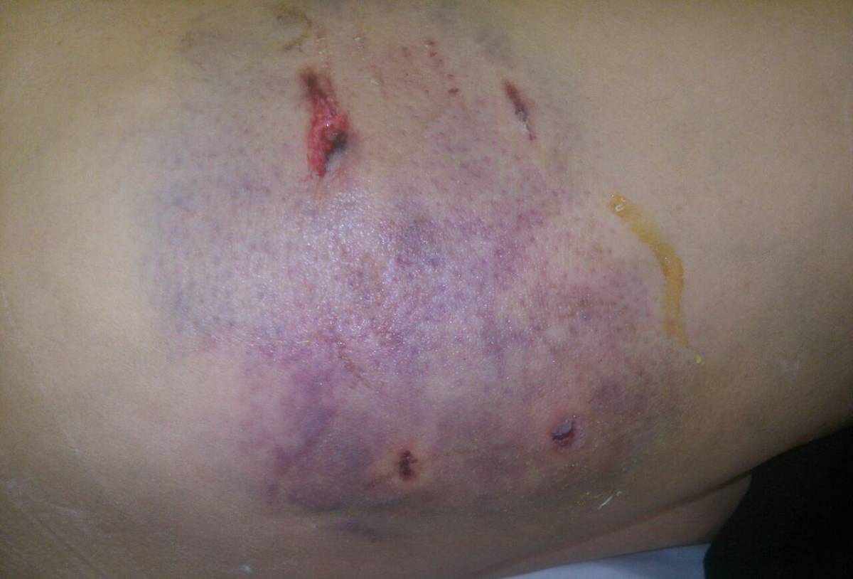 Una mujer fue mordida por perros | Bariloche 2000 - Diario digital de San Carlos de Bariloche