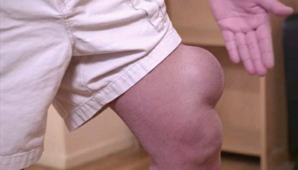 사과 크기의 커다란 피지낭종 짜기 | 인스티즈