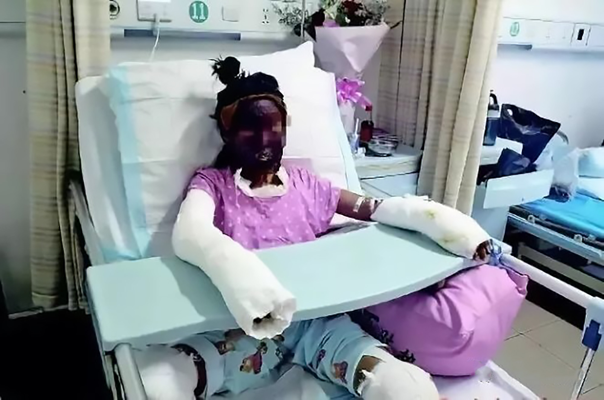 Girl With 90 Percent Burns From DIY Popcorn Machine Dies - ViralTab