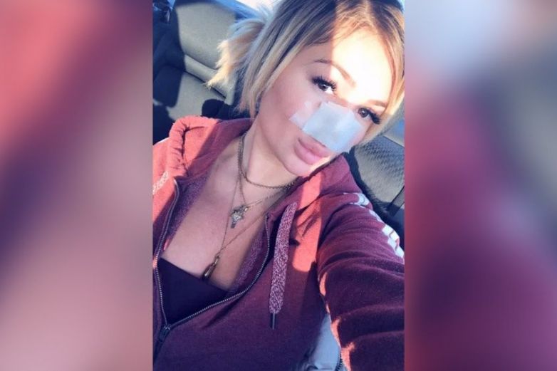 Muerde y arranca pedazo de nariz a mujer por terminar con él