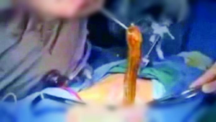 Hombre se mete anguila para curar estreñimiento | El Gráfico Historias y noticias en un solo lugar