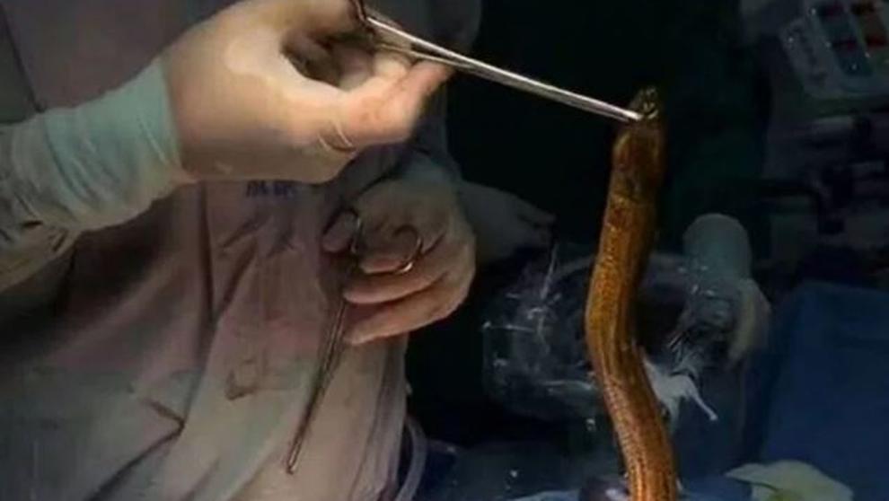 Un hombre acude a urgencias con una anguila en el intestino