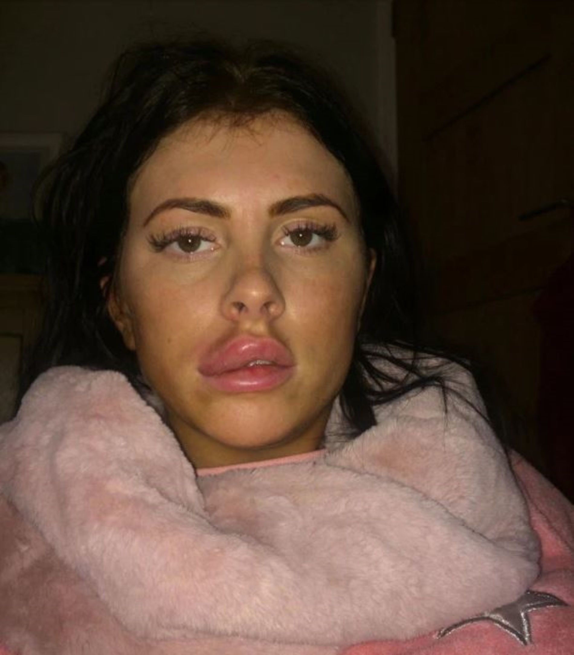 Se opera los labios, le explotan y casi se queda ciega de un ojo