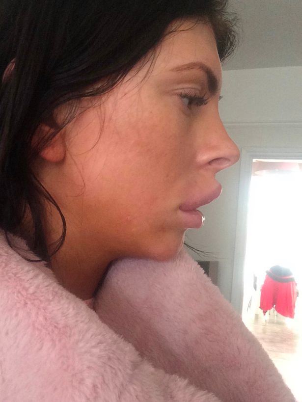 Le explotó el labio, la infección le llegó al ojo y ahora teme quedarse ciega - Radio Mitre