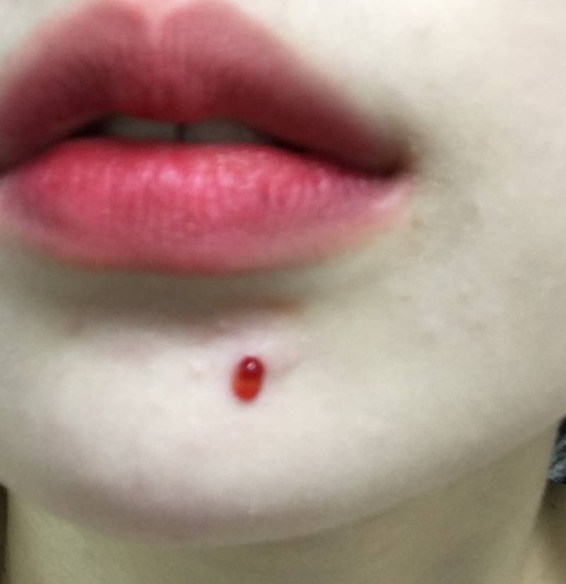 ㅋㅋㅋㅋㅋㅋㅋㅋㅋㅋㅋ밖인데 턱드름 터짐 여드름 주의 - 인스티즈(instiz) 익명잡담