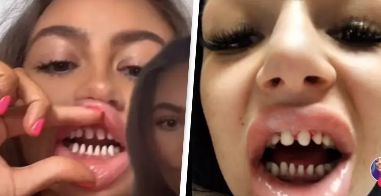 Dentists Are Slamming TikTok Stars For Shaving Down Their Teeth