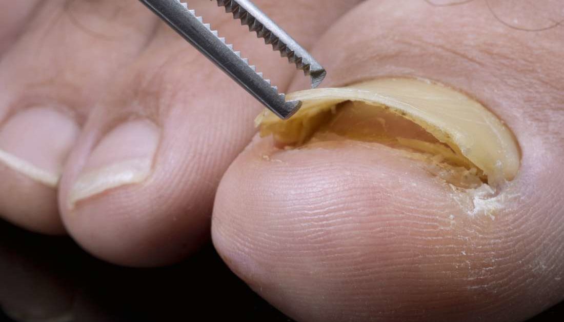 removing-my-fingernail-amputating-my-fingernail-link-in-description