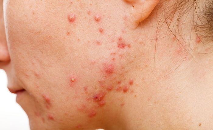 겨울철 목에 난