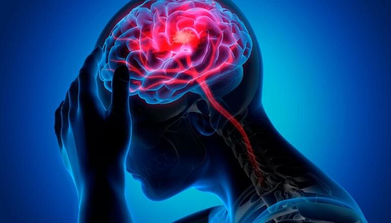 Alimentos que ayudan a prevenir o tratar la migraña - ADN Cuba