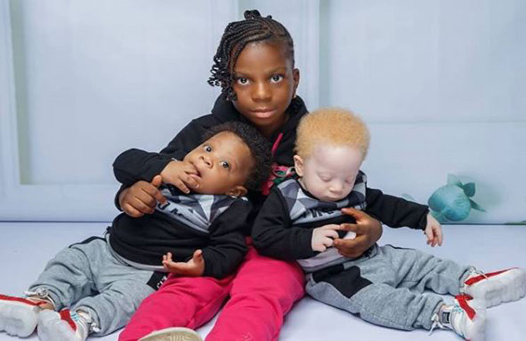 Son bebés mellizos “casi iguales”, pero de diferente color de piel - La 100