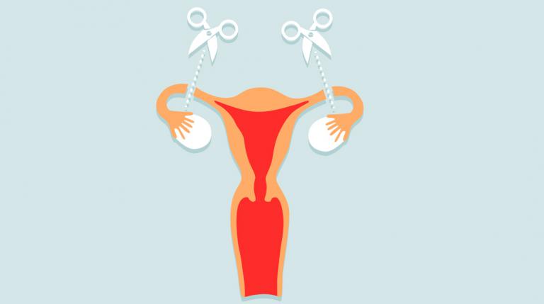 Ligadura de trompas, qué es y cuándo y para qué se realiza