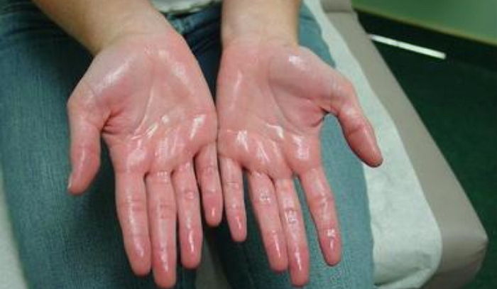 가만히 있어도 손에 땀 줄줄 나는 