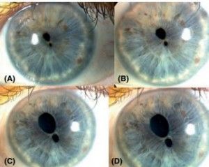 double pupil contact lense