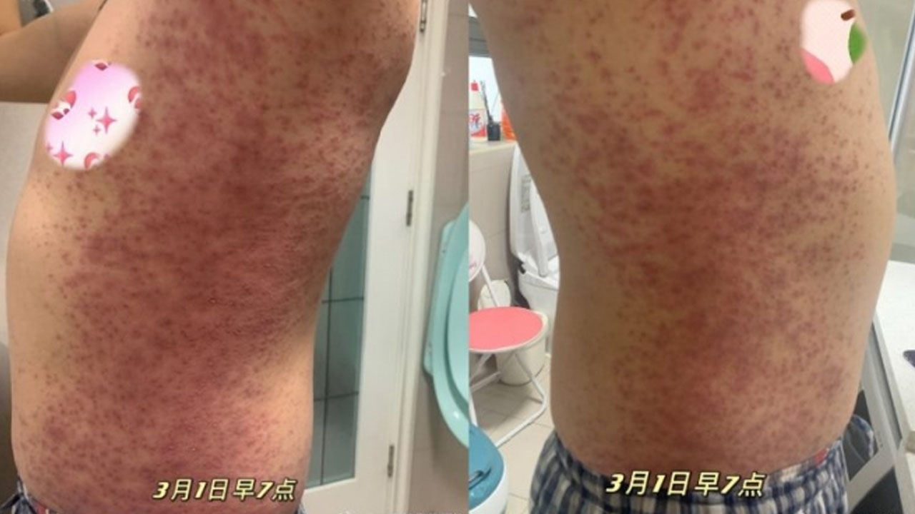 중국 백신 시노팜 맞고 붉은 반점...