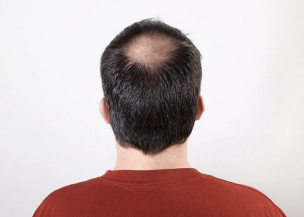 禿頭怎麼辦？快速了解禿頭前兆、原因、治療方式！ - 高地植髮家