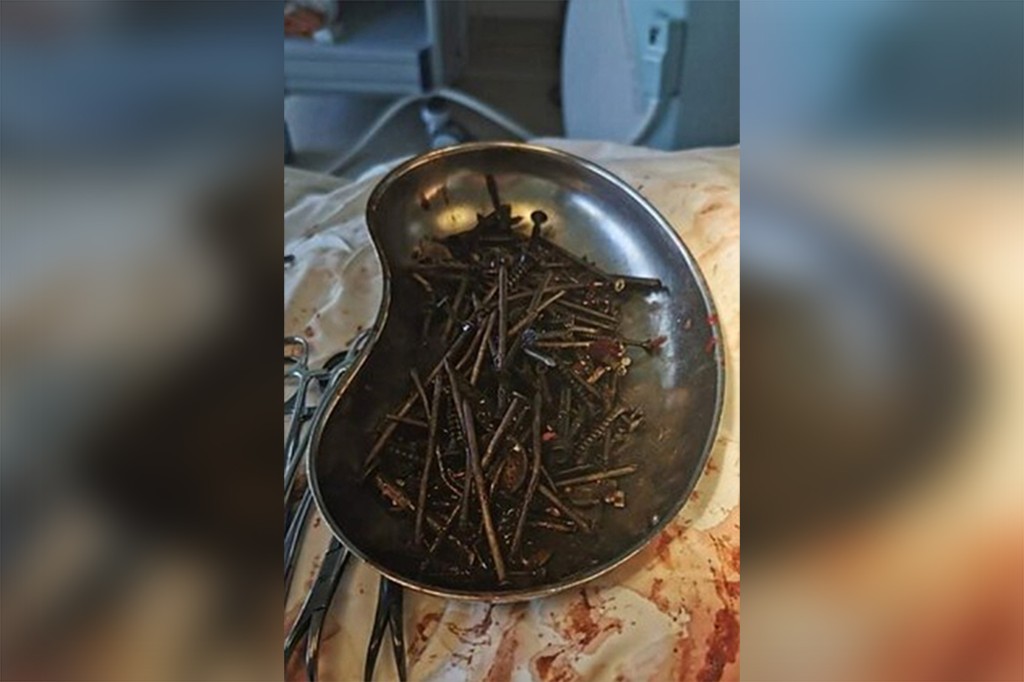 The surgery lasted for three hours during which doctors removed nails, screws, nuts and knives from the man