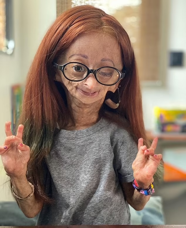 Girl Who Inspired Millions While Living With Real-Life Benjamin Button ...