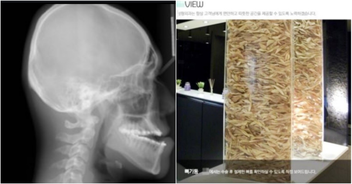 collage 474.jpg - "이게 바로 턱뼈 '탑'입니다.." 해외에 보도되면서 전 세계 조롱거리가 되고 있는 한국 성형외과 '턱뼈탑' 사건