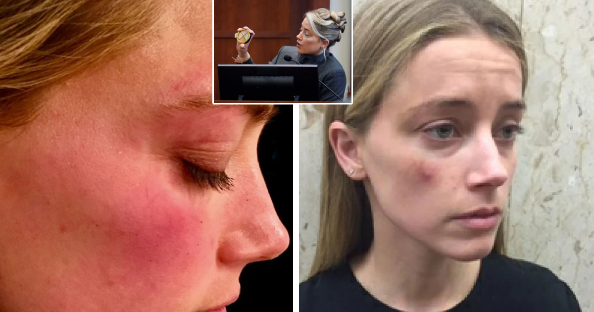 d5.png - BREAKING: Amber Heard Releases Startling & Troubled Images Of Abuse Inflicted By Johnny Depp