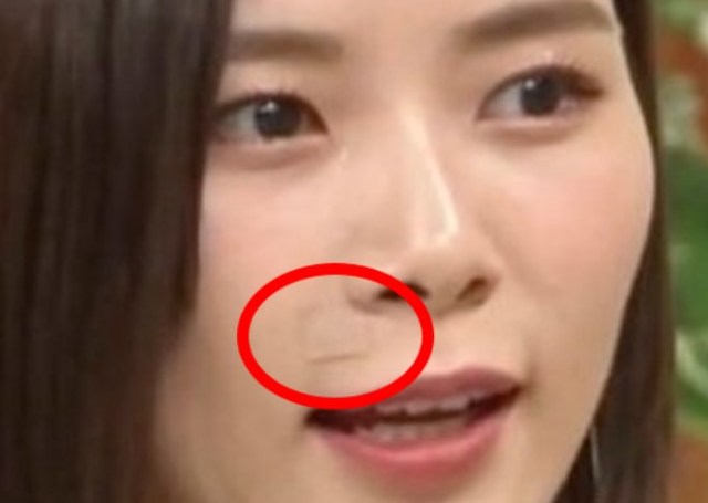 画像】朝日奈央 ほくろ除去した!テープ(絆創膏)は手術後か? | black-newstv