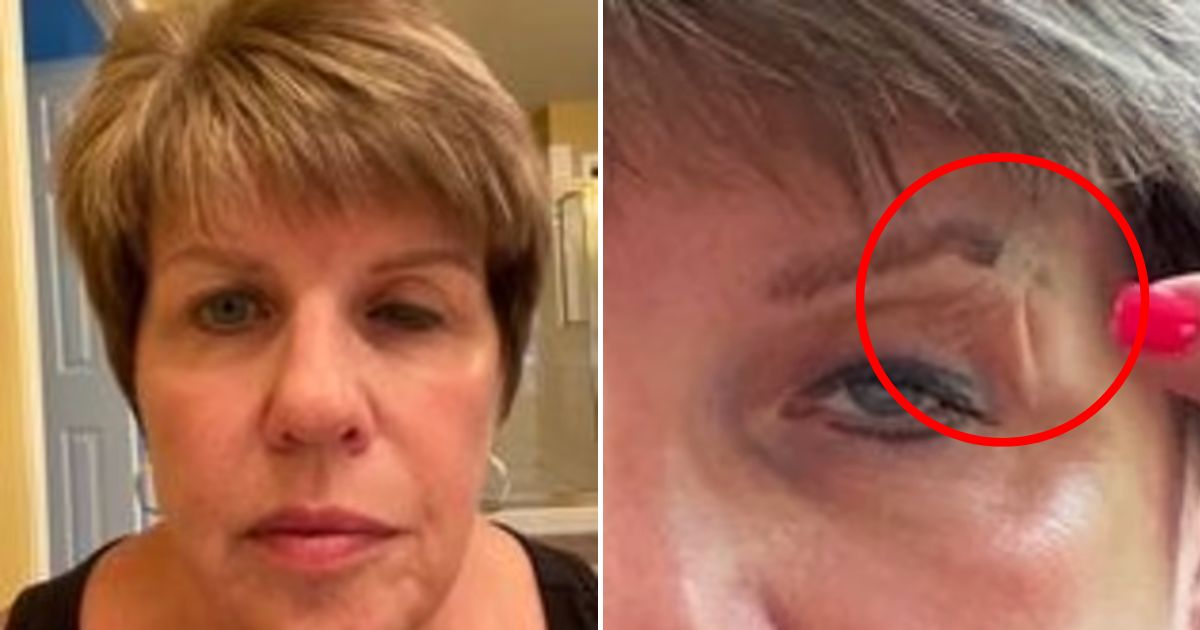 eye.jpg - 55-Year-Old Woman Was Left BLIND And Had To TAPE Her Drooping Eyelid Open To See After Visiting A Local Spa To Get Botox