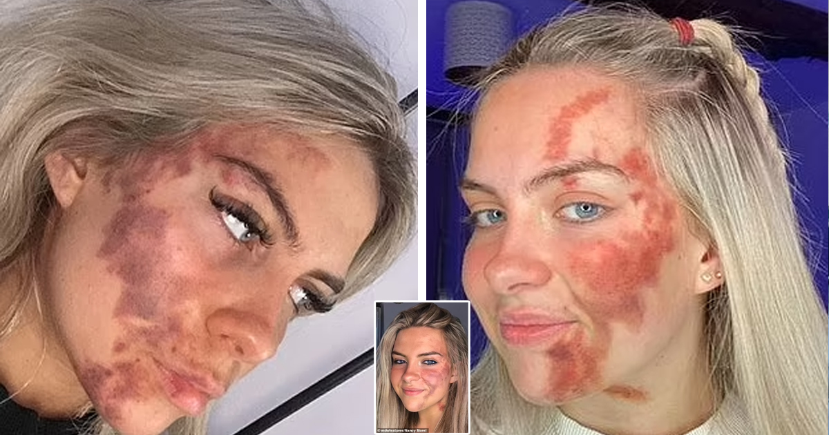 d45.jpg - 18-Year-Old Student Leaves Doctors STUNNED With Her 'Painful' Skin Condition That Allows Her Face To Bruise From Within