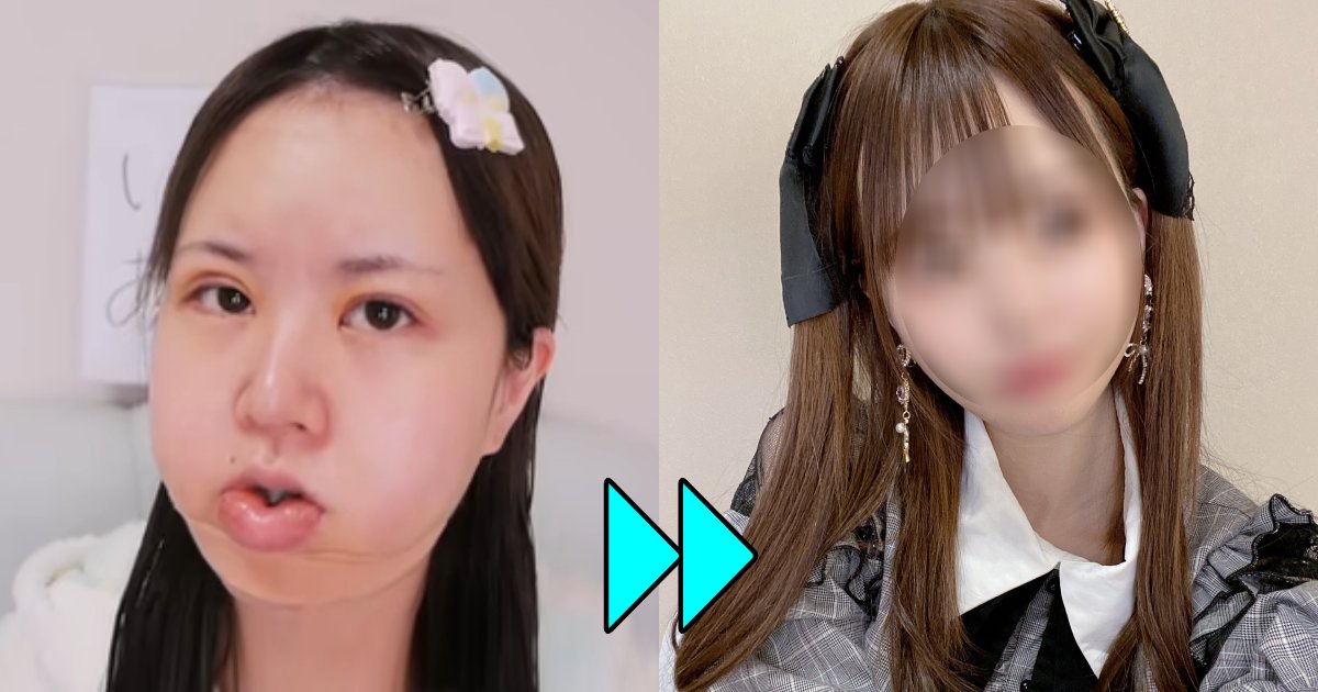 1350万円掛けた整形、あなたの目にはどう映る?「この顔で?金ドブじゃん」批判殺到も「自分が良ければそれでいい」 e696b0e8a68fe38397e383ade382b8e382a7e382afe38388703 1.png?resize=1200,630 - 1350万円掛けた整形、あなたの目にはどう映る?「この顔で?金ドブじゃん」批判殺到も「自分が良ければそれでいい」