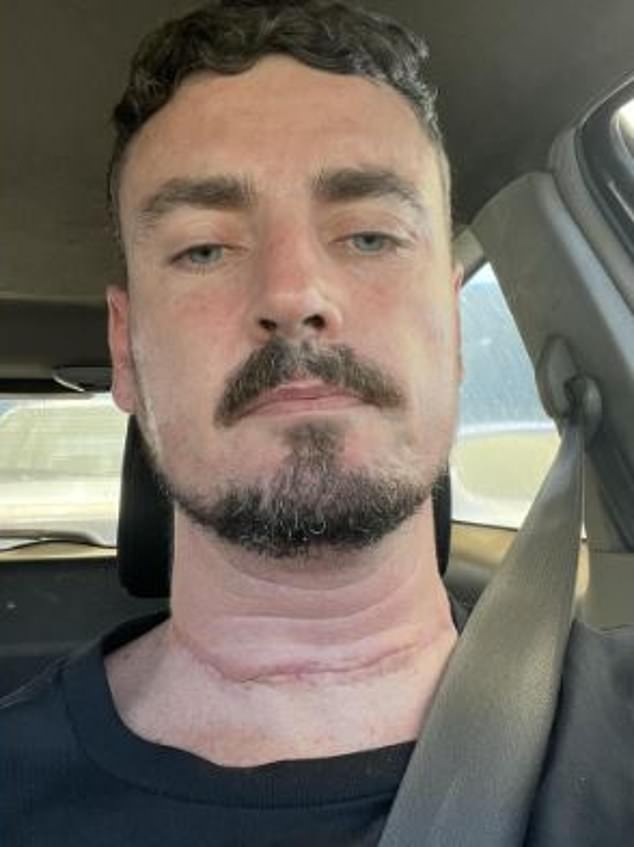 After his lymph nodes were removed Nicholas found another lump behind his ear - he revealed that