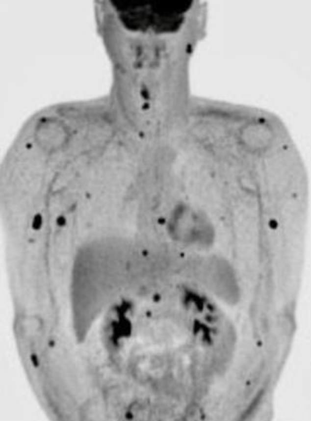 A PET scan revealed the cancer had spread throughout his body, into many of his organs and even his spine