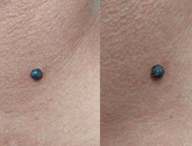 Doctors dismissed Nicholas when he asked about the mole - despite it doubling in size in just 11 days - so he went to a skin specialist