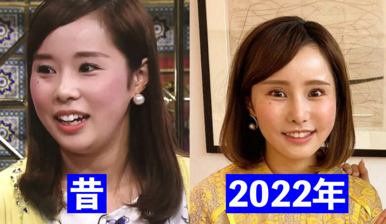 馬場ももこ顔が変わって怖い!整形総額200万円?!比較画像で検証