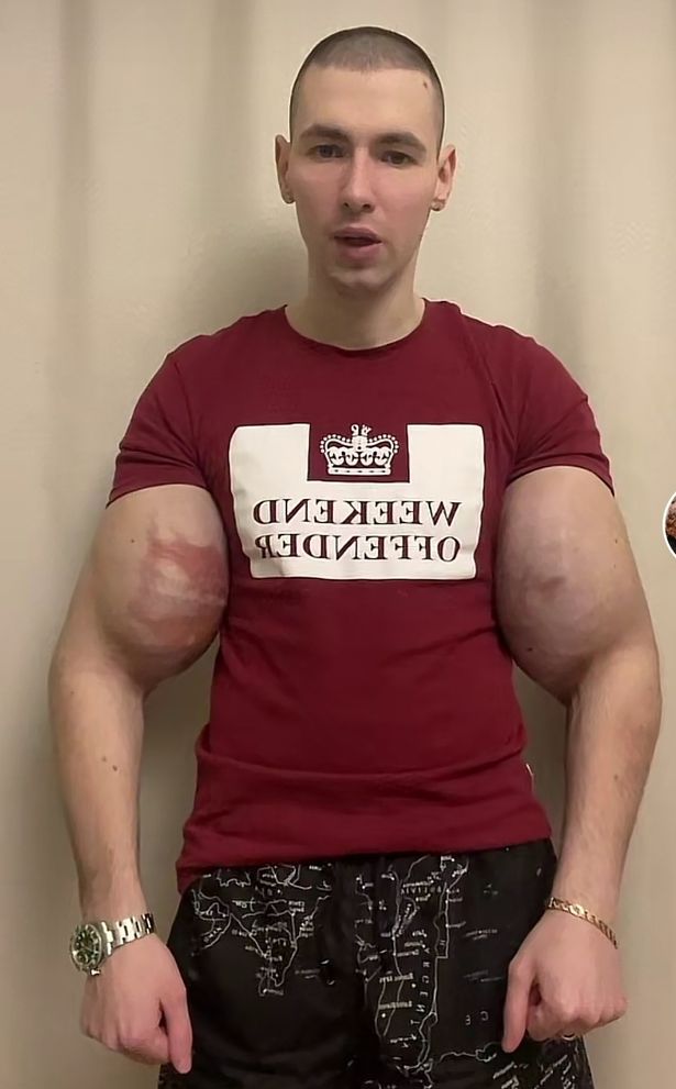 Bodybuilder Who Gained Viral Fame For Injecting Oil Inside His Arms Is