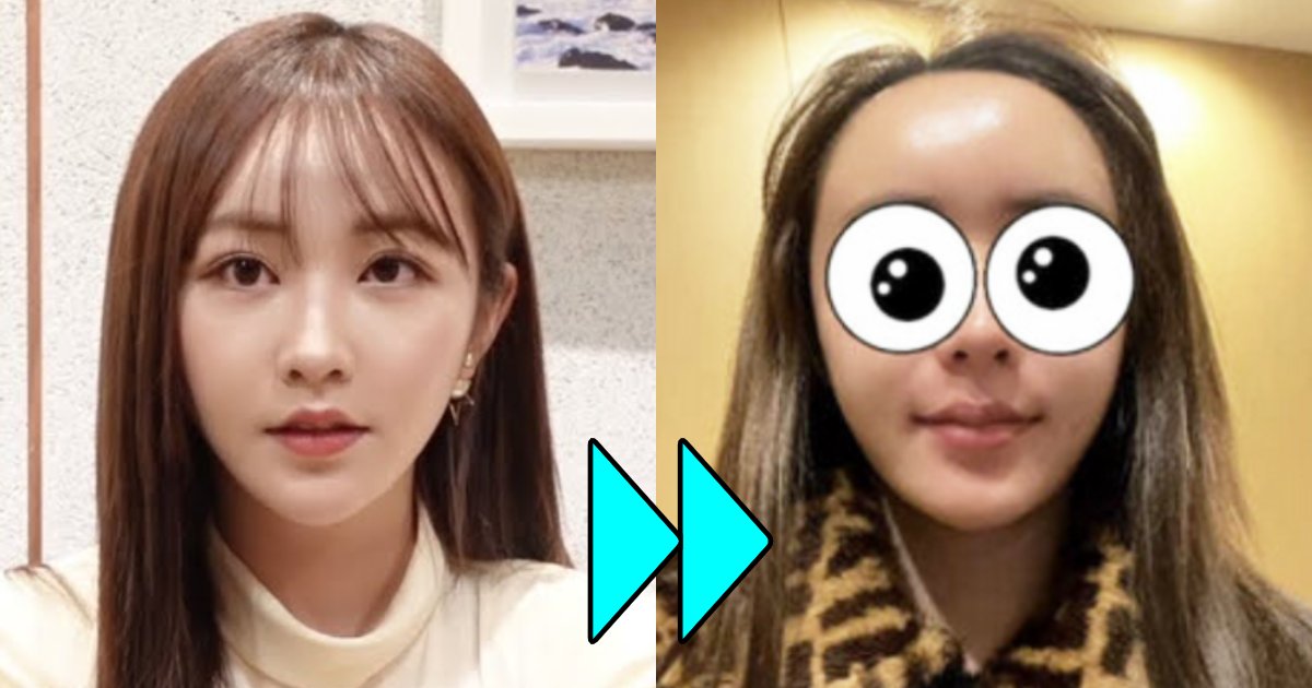 てんちむ、整形後のダウンタイム公開。痛々しいほど腫れ上がった額に「コブダイを超えた…」「整形失敗じゃなくて?」