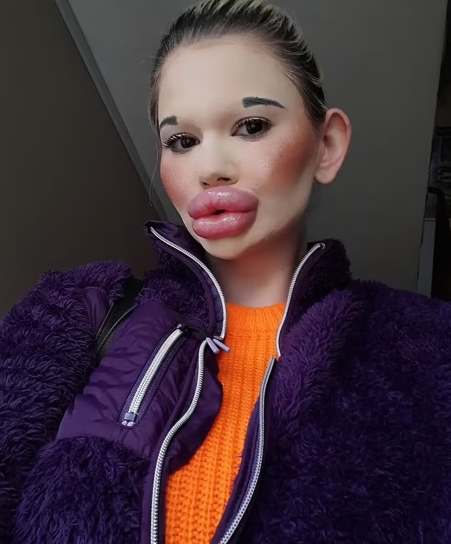 Woman With The World's Biggest Lips Says Men Want To Take Her On Dates ...