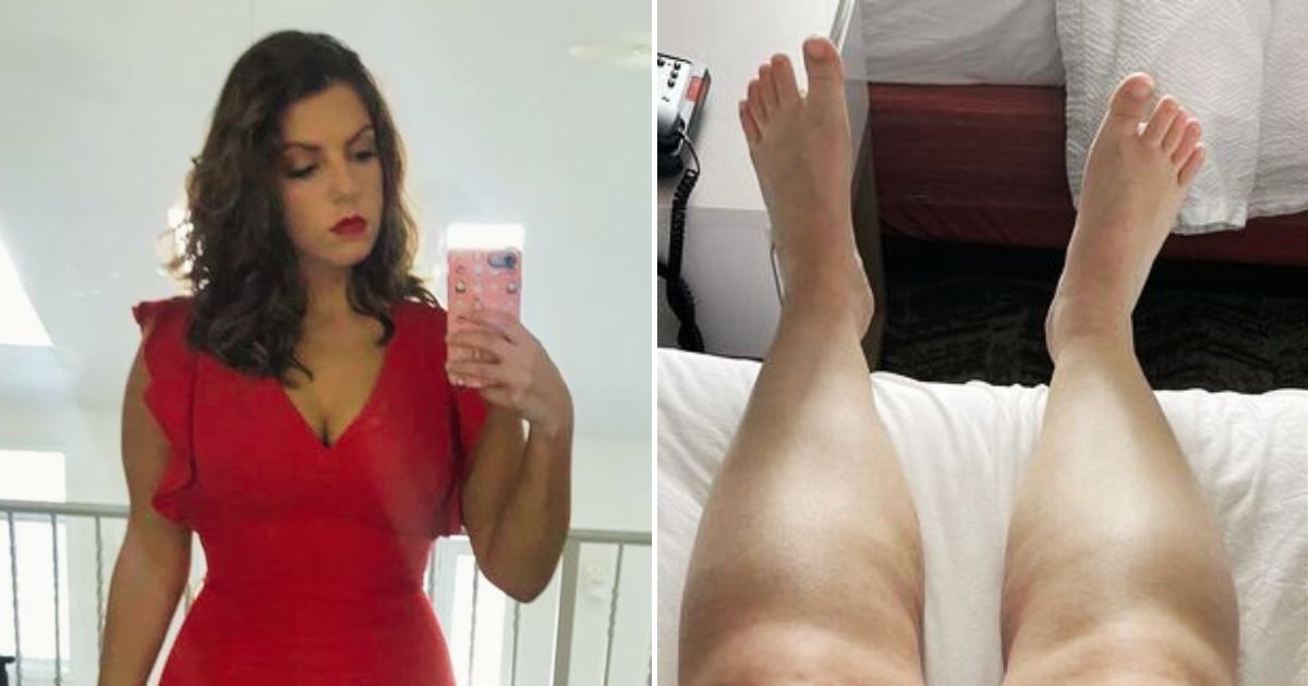 alisa4.jpg - 28-Year-Old Woman Had More Than 6 LITERS Of Fluid Drained From Her Body After She Discovered She Had A Rare Condition