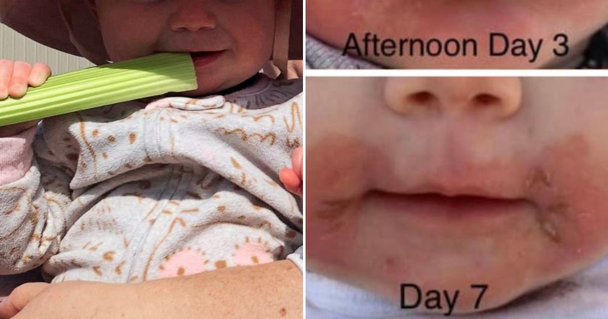 celery4.jpg - Mother Issues Desperate WARNING After Baby Developed Painful Burns Around Her Mouth When Eating Celery Sticks