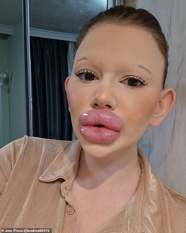 Woman With World's Biggest Lips Undergoes SIX Plastic Surgeries In One ...