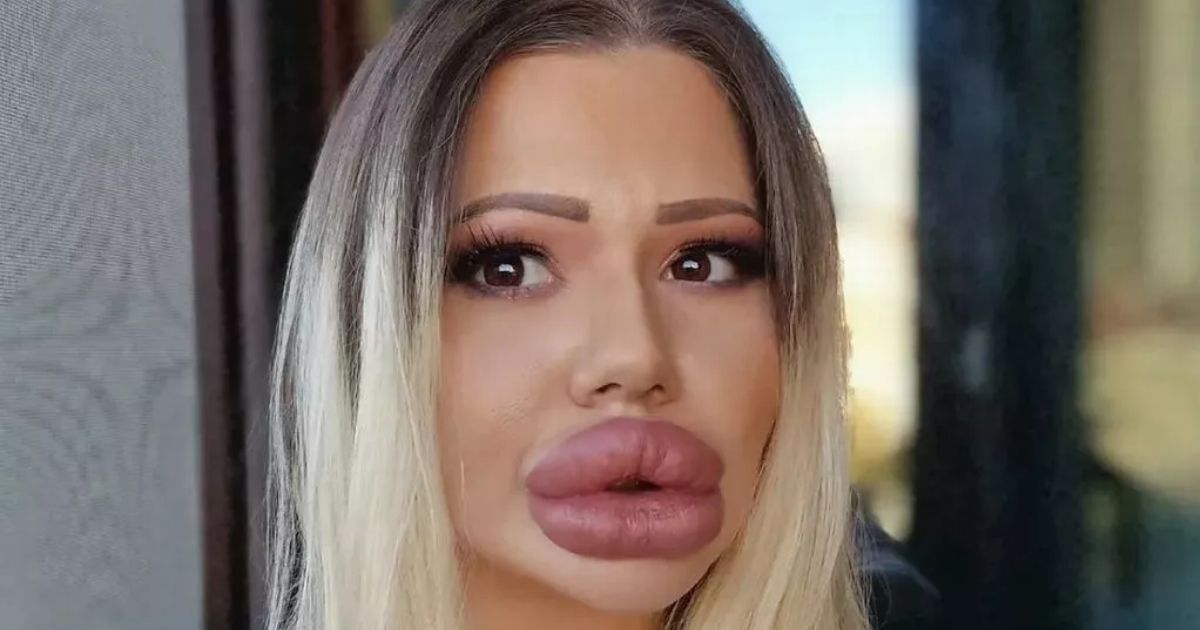 copy of articles thumbnail 1200 x 630 2025 07 04t205854 742.jpg - Woman with World's Biggest Lips Is In SEVERE Pain But Doctors REFUSE To Touch Her